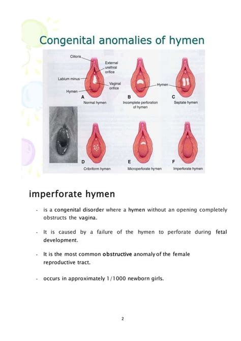 imperforate hymen|Imperforate Hymen